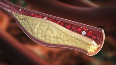 Arteria entupida 370x208 - 10 problemas de saúde causados pelo excesso de açúcar